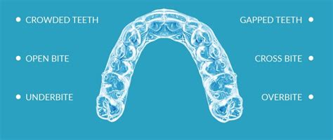 Contra-indications for Clear Aligner - PhiAligner KnowledgeBase