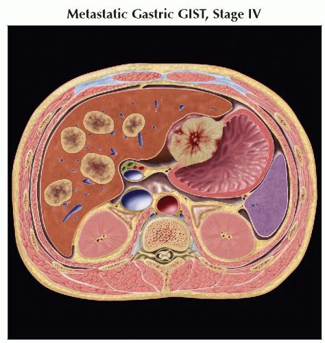 Gastrointestinal Stromal Tumor (GIST) | Radiology Key