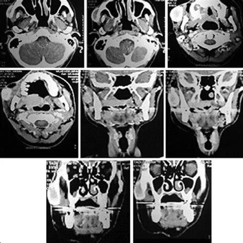 CT image, Axial view, soft tissue windowing, showe a soft tissue mass... | Download Scientific ...