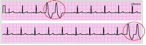 Recognizing ECG Irregularities | Favoriteplus.com Blog