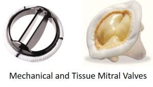 Mitral Valve Repair Surgery – What You Need To Know • MyHeart