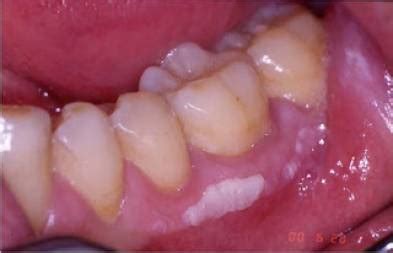 Leukoplakia (White Patch on Gums): Causes and Treatment