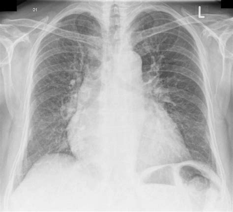 Vascular congestion definition & pulmonary vascular congestion