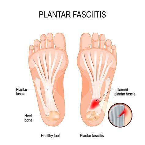 Home Remedies for Heel Pain and the Plantar Fascia