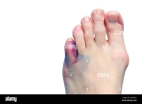 A bruised toe Stock Photo - Alamy