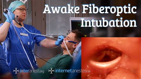 Awake Fiberoptic Intubation - YouTube