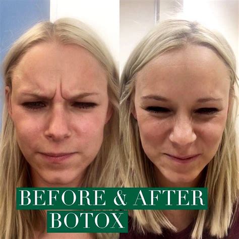 Liquid Facelift With Botox Before And After | Liquid facelift, Facelift ...