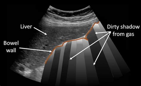 Ultrasound Case 089 • LITFL • POCUS Self-Assessment Quiz