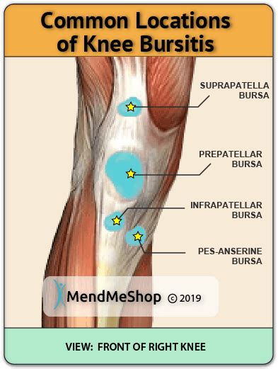 Bursitis in the Knee