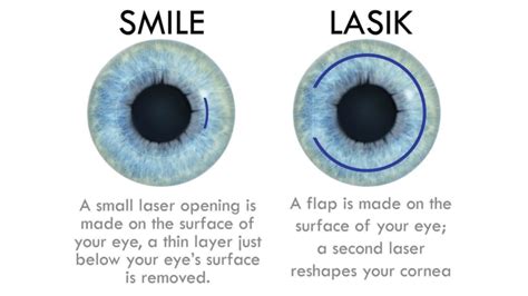 Smile Laser Surgery: Advantages, Limitations, And Complications