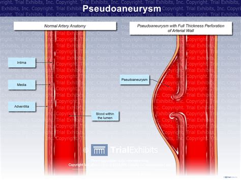 Pseudoaneurysm - TrialQuest Inc.