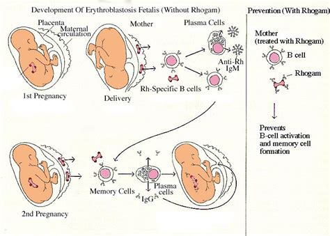 Rh Hemolytic Disease Of The Newborn Hematology