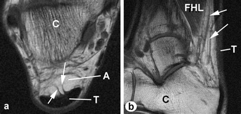 The functional anatomy of Kager's fat pad in relation to retrocalcaneal ...