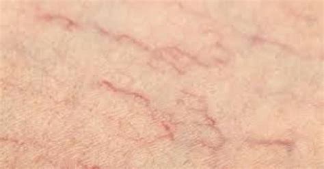 Spider Veins / Telangiectasia | Healthium Clinics