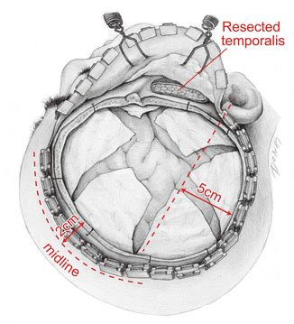 Decompressive Hemicraniectomy for Malignant Hemispheric Infarction ...