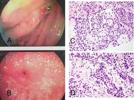 A, B Gastroscopy -granular, erythematous mucous membrane in the antrum | Download Scientific Diagram