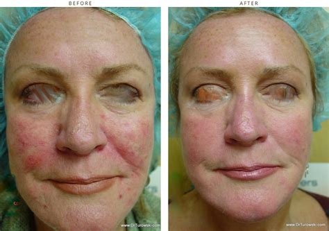 Intense Pulse Light (ipl) – Before and After Pictures * | Dr Turowski ...