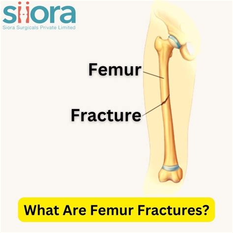 What Are Femur Fractures? - An Educational Guide