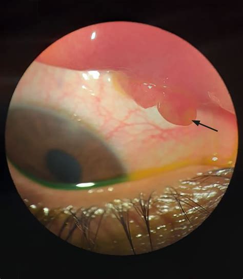 Community Eye Health Journal » Conjunctival pyogenic granuloma following insect bite