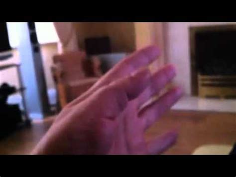 Neuromyotonia Thumb - YouTube