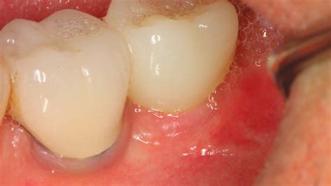 Titanium vs. Ceramic Dental Implants