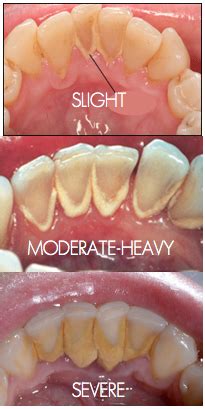 The Difference Between Plaque and Tartar - River Run Dental