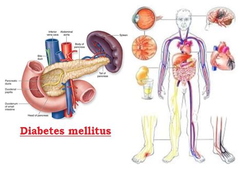 Diabetes Mellitus Causes