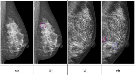 MCC detection results. (a) The original mammogram. (b) The... | Download Scientific Diagram