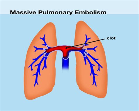 What are the symptoms of a blood clot? | UNC Hemophilia and Thrombosis Center