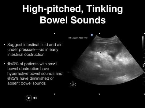 Bowel sounds/ultrasound | Block 3 Session 2: Bowel sounds/ultrasound. In this video we will ...