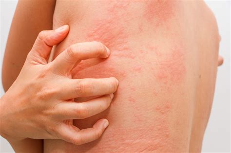 Skin Allergies & Rashes: Do You Know What to Do? - Aesthetic & Dermatology Center