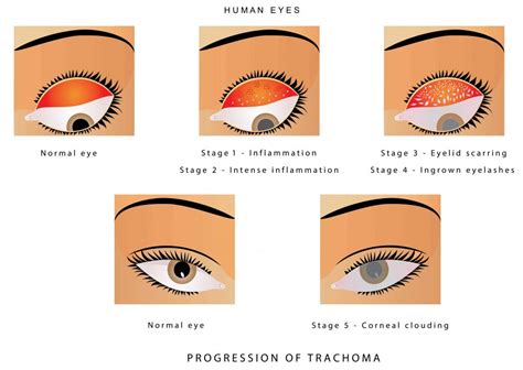 5 Major Challenges In Ophthalmology In Developing Countries