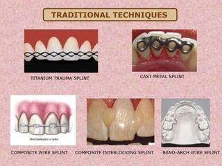 Dental splinting | PPT