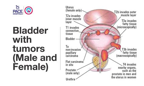 Transurethral Resection Of The Bladder