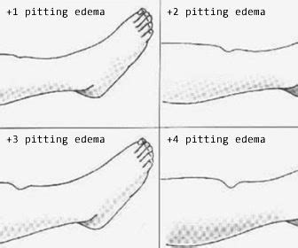 Pitting Edema Grading Chart