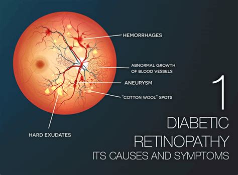 Diabetic Retinopathy Part 1: Its Causes and Symptoms | Fairfax VA | Vienna Eyecare Center