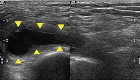 Ischial bursitis definition, causes, symptoms, diagnosis & treatment