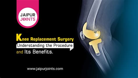 Knee Replacement Surgery: Procedure and Its Benefits 2023