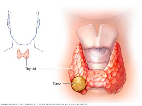 Thyroid cancer - Symptoms and causes - Mayo Clinic