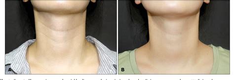 Figure 1 from Novel Treatment of Neck Wrinkles with an Intradermal ...