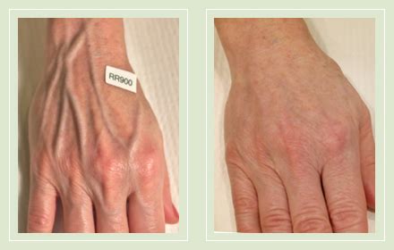 Hands – The Vein Treatment Center