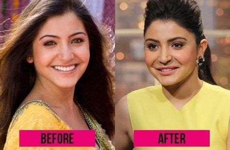 Anushka Sharma Photo Before and After Plastic Surgery | Bollywood ...