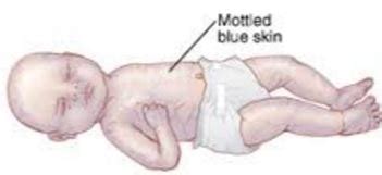 Mottled Skin - Pictures, What is, Causes, Treatment, Diagnosis