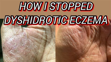 HOW I STOPPED DYSHIDROTIC ECZEMA ON MY PALMS FINGERS AND HANDS - YouTube