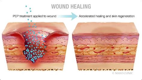 Mayo Clinic preclinical discovery triggers wound healing, skin ...