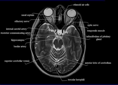 Brain anatomy, Radiology, Mri brain