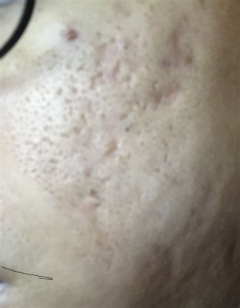 Help with pitted scars - Hyperpigmentation - red/dark marks - Acne.org