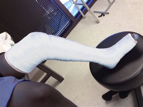 Cast Kit - Long Leg - Fiberglass - A-1 Medical Integration