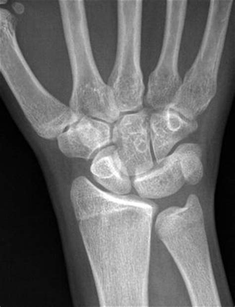 The Hand and Wrist: Congenital and Developmental Conditions | Radiology Key