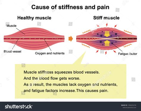 Cause Muscles Stiffness Pain Illustration Explanation: vector de stock (libre de regalías ...